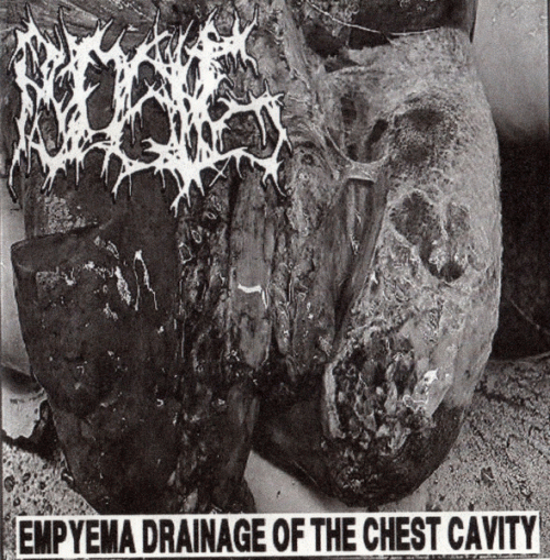 Empyema Drainage of the Chest Cavity